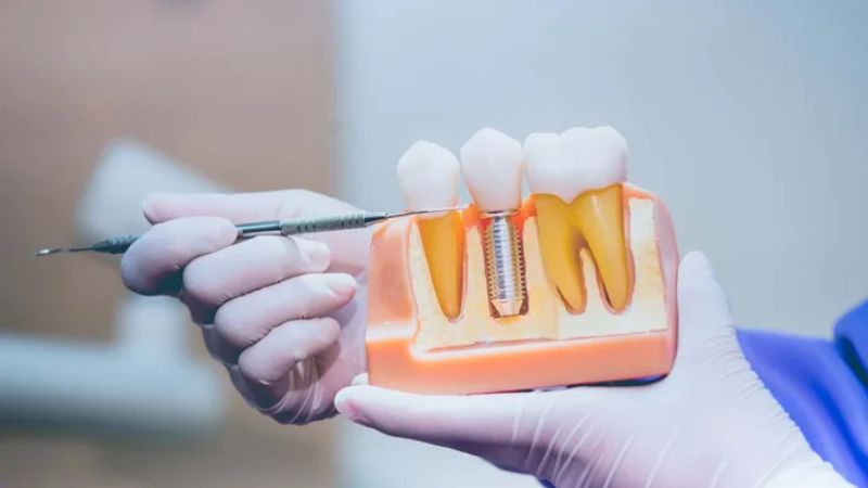 Review trồng răng Implant: Kinh nghiệm thực tế từ khách hàng và nha sĩ Người có xương hàm còn đủ thể tích thì khả năng làm Implant sẽ thành công cao