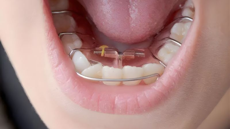 Sau khi niềng răng đeo hàm duy trì bao lâu? Hỏi đáp bác sĩ Duy trì đeo hàm liên tục lâu dài vào ban đêm giúp bảo toàn kết quả chỉnh nha