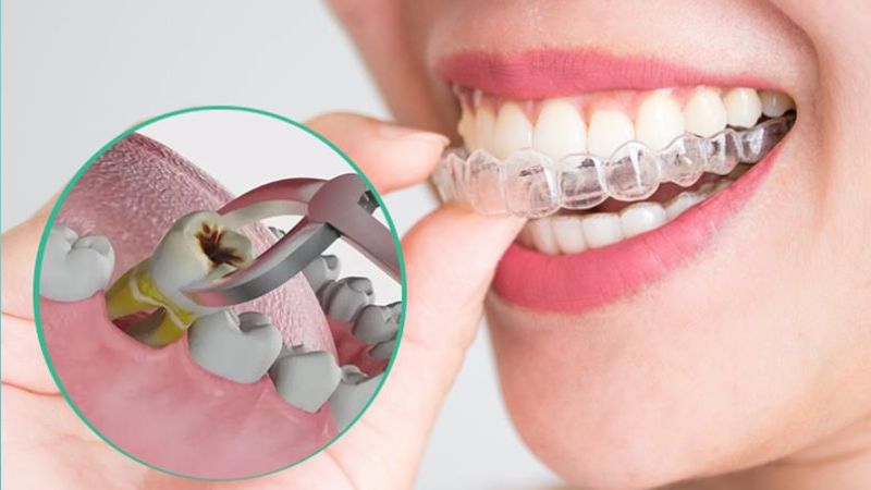 Sau khi niềng răng đeo hàm duy trì bao lâu? Hỏi đáp bác sĩ Người niềng răng có nhổ răng cần đeo hàm duy trì lâu hơn bình thường