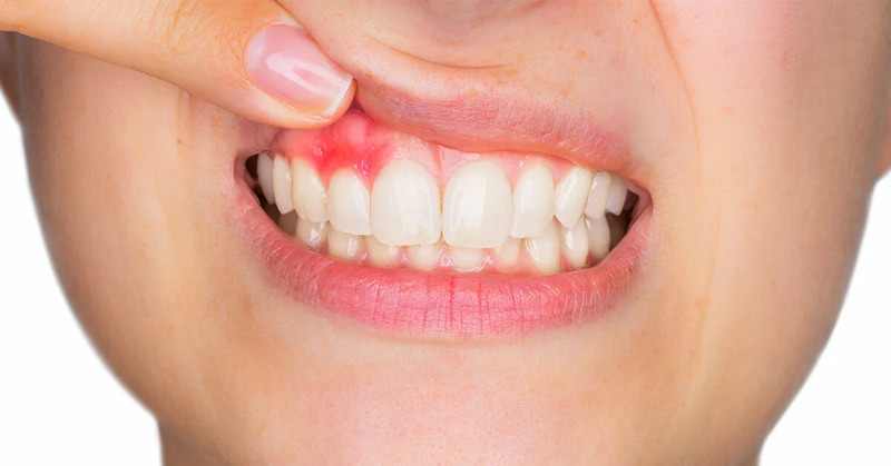 Sau khi trồng răng Implant nên ăn gì và không nên ăn gì? Đồ ăn cay nóng hoặc nhiều gia vị dễ gây kích ứng mô nướu và viêm quanh trụ