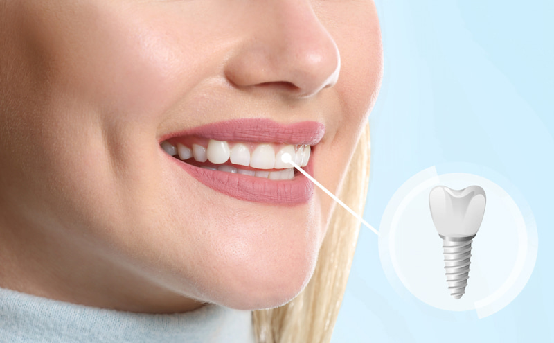 Người bị tiểu đường có trồng răng Implant được không? Người đái tháo đường làm Implant cần đảm bảo xương hàm đủ mật độ, thể tích