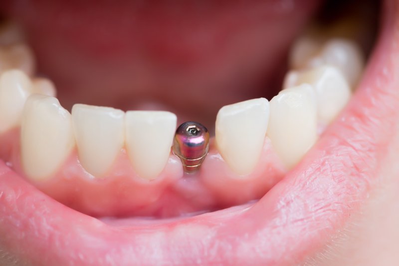 Bác sĩ tư vấn trồng răng Implant có niềng răng được không? Bác sĩ tiến hành chỉnh nha nếu Implant không nằm trong vùng kéo răng