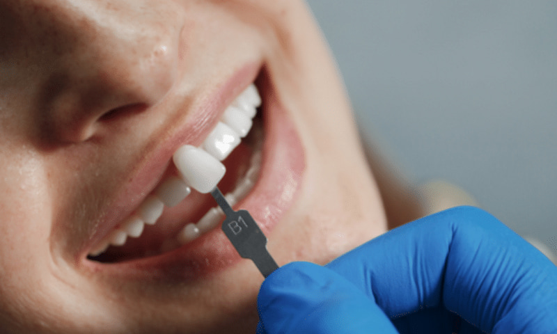 Trồng răng sứ bị đen chân răng: Nguyên nhân và cách khắc phục Kỹ thuật phục hình không chuẩn xác tạo khe hở viền nướu gây sậm màu