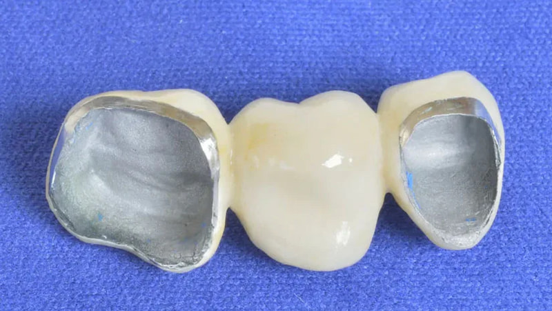 Trồng răng sứ kim loại có tốt không? Chi tiết ưu nhược điểm Trồng răng sứ kim loại được đánh giá tốt về mặt chi phí