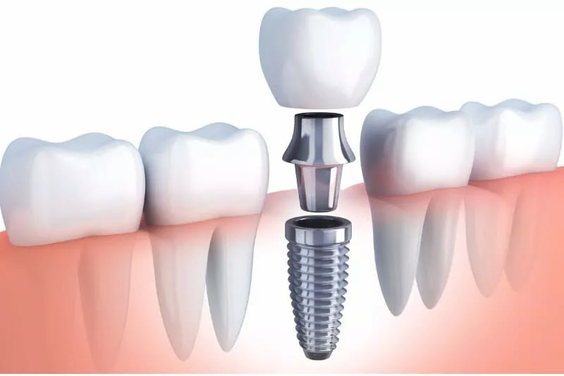 Trồng răng sứ mất bao lâu thời gian? Những lưu ý quan trọng Trồng răng sứ bằng trụ Implant là phương pháp có thời gian thực hiện dài nhất