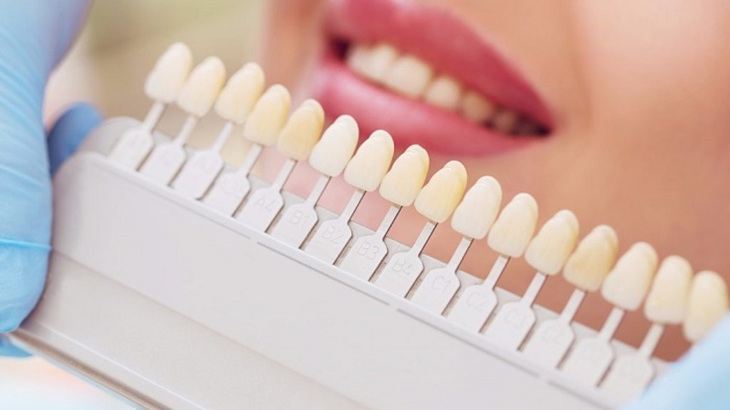 Trồng răng sứ titan có tốt không? Ai nên trồng? Răng sứ titan dễ bị xỉn màu theo thời gian