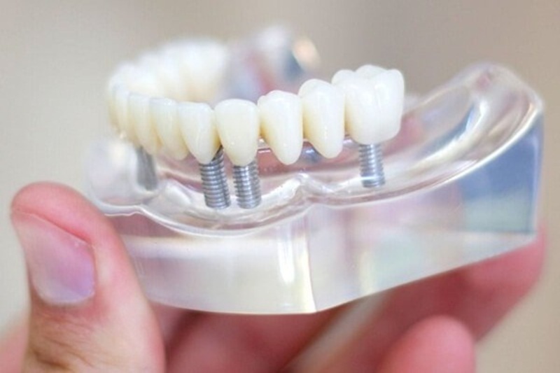 Trồng răng sứ titan có tốt không? Ai nên trồng? Tuổi thọ của răng sứ titan khoảng 5-10 năm