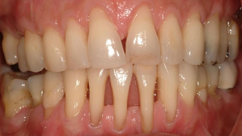 Dấu hiệu viêm nha chu: Nhận biết sớm để tránh mất răng Khi viêm nha chu tụt lợi có thể thấy chân răng lộ rõ và dài hơn bình thường