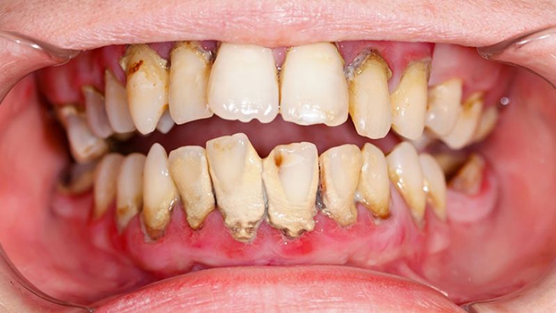 Dấu hiệu viêm nha chu: Nhận biết sớm để tránh mất răng Khi viêm nha chu hoại tử cần can thiệp điều trị chuyên sâu