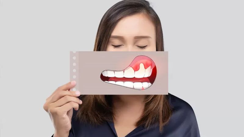 Bị viêm nha chu nên ăn gì? Danh sách thực phẩm cần tránh Viêm nha chu cần kiêng ăn uống để tránh những tác động tiêu cực lên nướu và răng