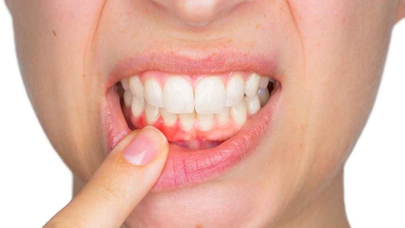 Cách chữa viêm nha chu răng hiệu quả theo từng mức độ Viêm nha chu có thể chữa dứt điểm nếu phát hiện sớm