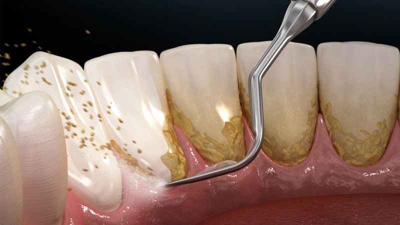 Cách chữa viêm nha chu răng hiệu quả theo từng mức độ Loại bỏ tận gốc nguyên nhân là nguyên tắc quan trọng trong cách chữa viêm nha chu răng