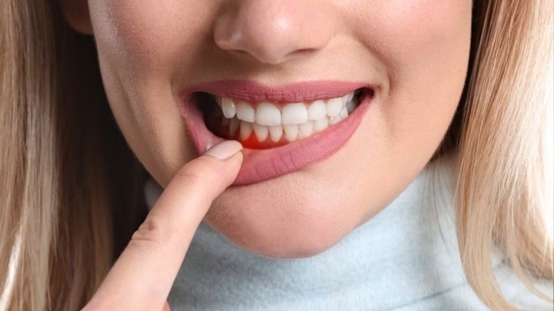 Cách chữa viêm nha chu răng hiệu quả theo từng mức độ Chữa viêm nha chu tại nhà không đạt được hiệu quả triệt để