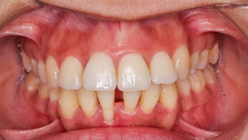 Tổng hợp các cách chữa viêm nha chu răng tại nhà hiệu quả Nếu bệnh ở giai đoạn nhẹ thì có thể điều trị viêm nha chu răng tại nhà