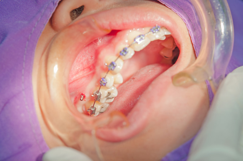 Cắm vít niềng răng có đau không và nguy hiểm không? Cắm vít niềng răng có đau không? Thường không đau hay chỉ ê nhẹ