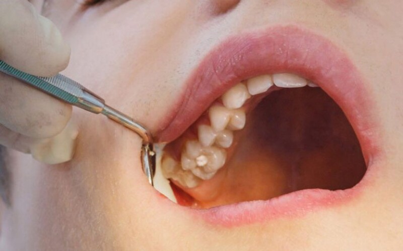 Đau đầu do mọc răng khôn có nguy hiểm không? Giải đáp từ chuyên gia Nhổ răng là giải pháp hiệu quả loại bỏ đau đầu do răng khôn mọc lệch