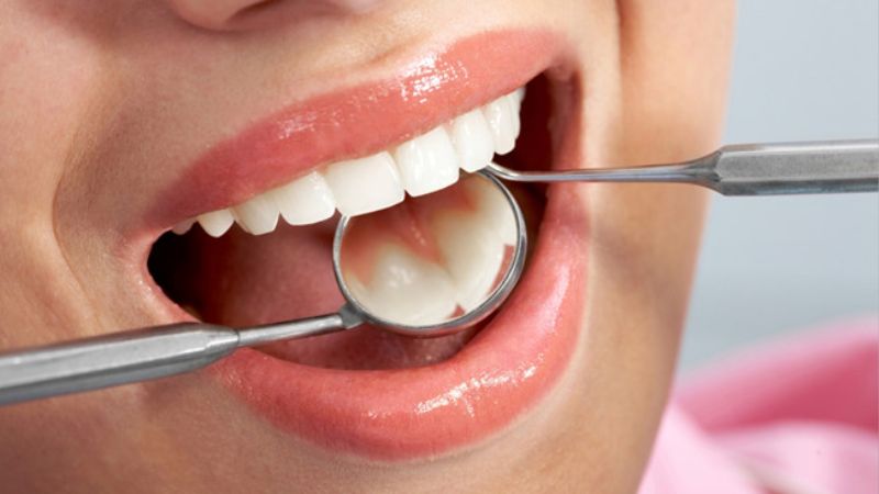 Đau kẽ răng là gì? Có nguy hiểm không? Trám phục hồi giúp điều trị dứt điểm đau kẽ răng