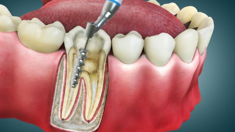 Đau răng ngậm gì để giảm đau nhanh và an toàn? Bác sĩ đáp Nếu nguyên nhân đau răng nằm ở tủy răng thì có ngậm đủ thứ vẫn không hết đau