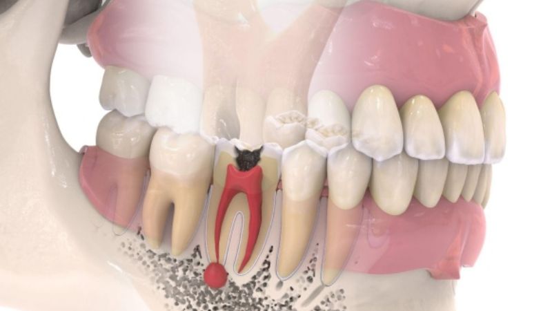 Đau răng nổi hạch dưới hàm? Khi nào nên thăm khám bác sĩ Khi nghi ngờ viêm tủy người bệnh không nên uống thuốc mà phải đi khám bác sĩ