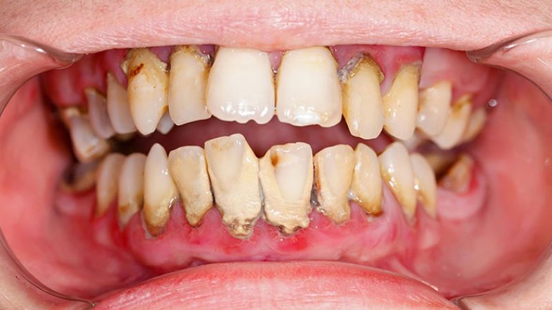 Giá điều trị viêm nha chu bao nhiêu tiền? Cách tiết kiệm chi phí Mức độ viêm nha chu là một trong những yếu tố quyết định đến giá dịch vụ