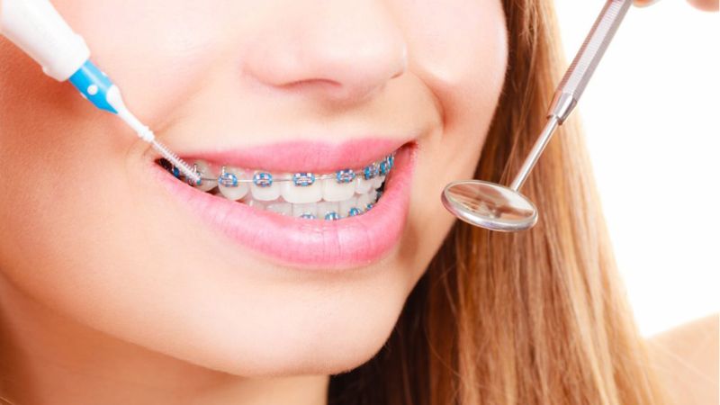 Niềng răng ăn mì được không? Hướng dẫn ăn mì đúng cách Vệ sinh răng miệng đúng cách sau ăn mì để tránh tích tụ mảng bám gây viêm