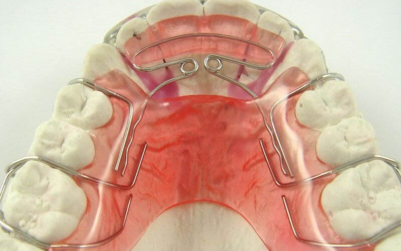 Niềng răng ốc nông rộng là gì? Bác sĩ giải đáp từ a–z Đeo ốc để nong hàm giúp mở rộng vòng hàm theo chiều ngang