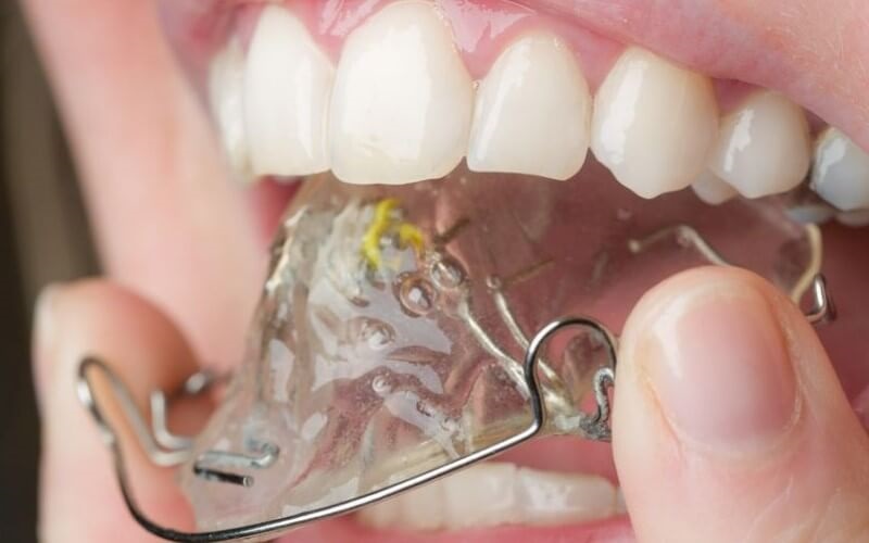 Niềng răng ốc nông rộng là gì? Bác sĩ giải đáp từ a–z Niềng sử dụng ốc nong rộng có gây đau trong 3-7 ngày đầu