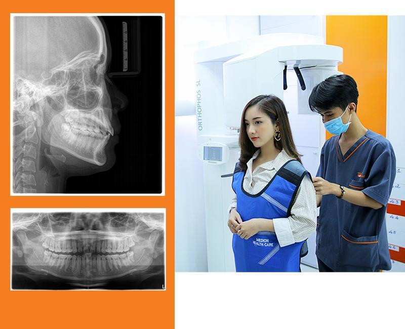 Răng số 6 bị sâu có nên nhổ không? Khi nào cần nhổ Nhổ răng số 6 hàm dưới có chụp X-quang đánh giá dây thần kinh