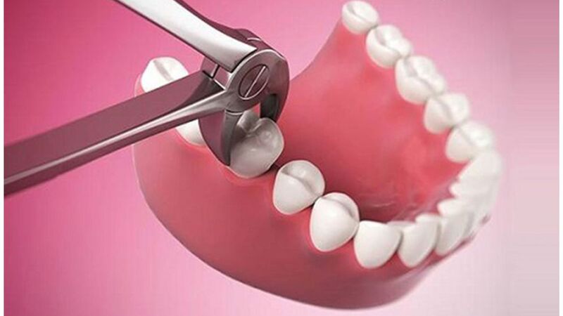 Răng số 6 bị sâu có nên nhổ không? Khi nào cần nhổ Chỉ định nhổ răng cấm số 6 do tổn thương nghiêm trọng