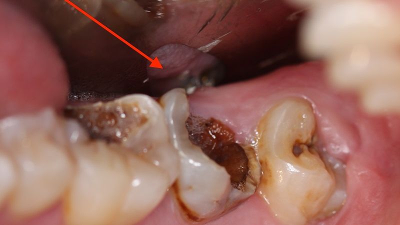 Sâu răng: Dấu hiệu nhận biết, cách điều trị theo từng mức độ Sâu tủy răng là mức độ nặng của bệnh lý sâu răng