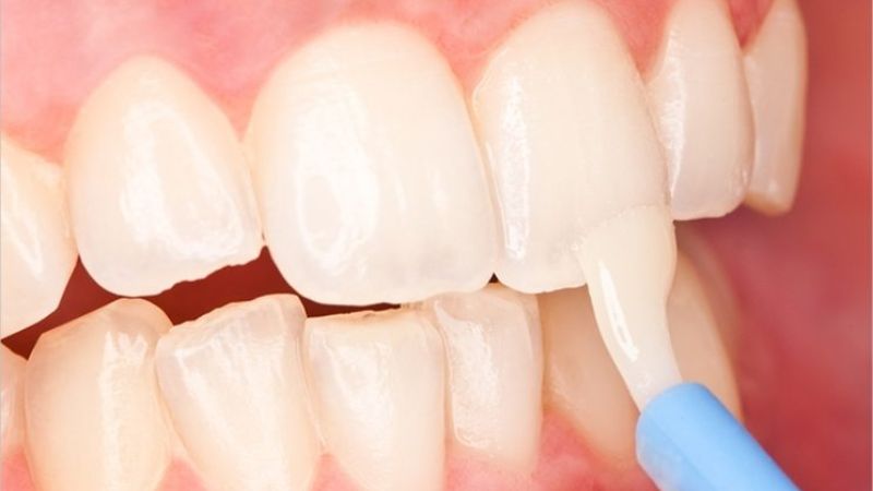 Các loại thuốc trị sâu răng được sử dụng phổ biến hiện nay Thuốc chấm/bôi trị sâu răng giúp tái khoáng, kiểm soát vi khuẩn và làm giảm cảm giác đau