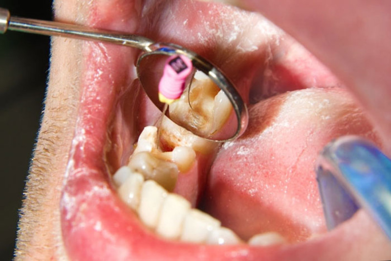 Trám răng sâu có lấy tủy không? Khi nào bắt buộc Cần thăm khám nha khoa trước khi quyết định trám hay lấy tủy