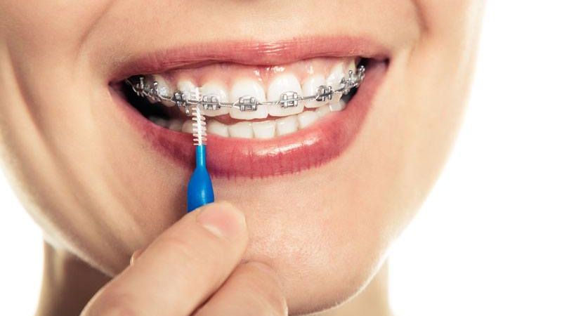 Viêm nha chu có niềng răng được không? Bác sĩ giải đáp Sau khi điều trị viêm nha chu ổn định, bác sĩ sẽ lập kế hoạch niềng răng