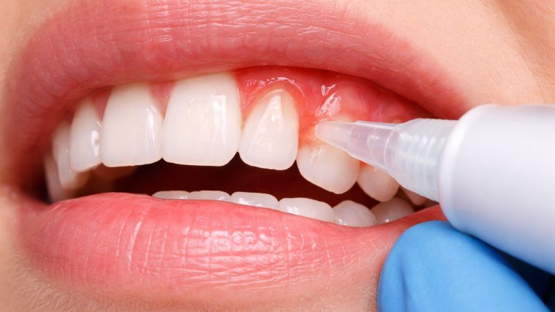 Viêm nha chu uống thuốc gì? Những sai lầm khi dùng thuốc Viêm nha chu uống thuốc gì? Gel kháng khuẩn là nhóm thuốc chữa viêm nha chu thường được bác sĩ chỉ định