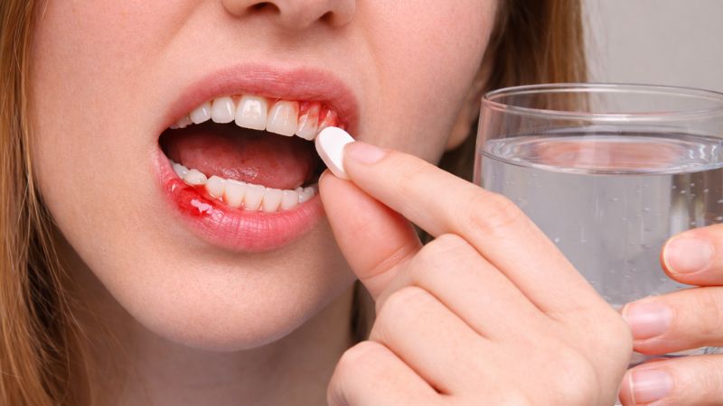 Viêm nha chu uống thuốc gì? Những sai lầm khi dùng thuốc Không nên tự ý mua thuốc điều trị viêm nha chu tại nhà