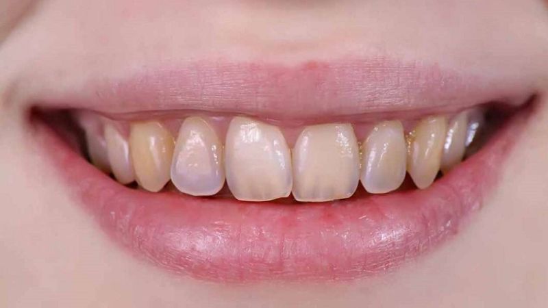 Bọc răng sứ Cercon có tốt không? Lưu ý quan trọng cần biết Với trường hợp răng bị mòn men, hư tổn lớn thì nên bọc răng sứ Cercon