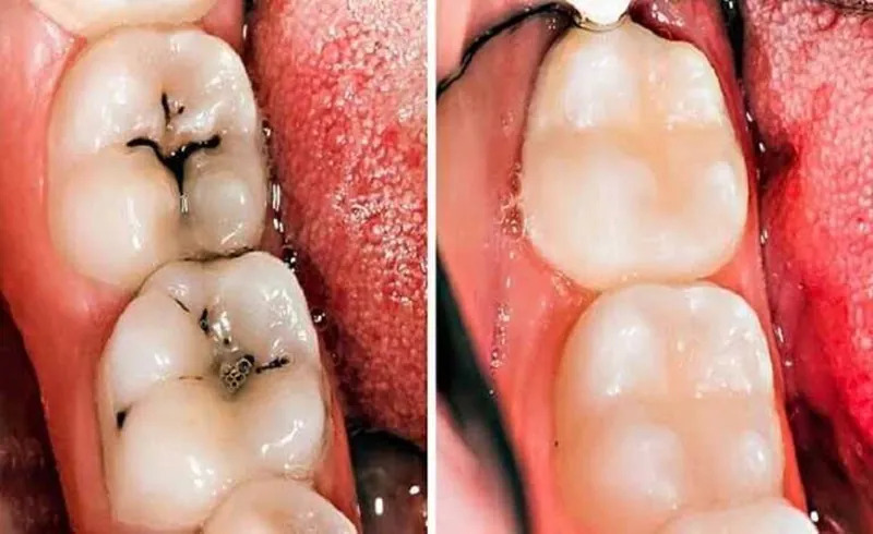 Bọc răng sứ có bị sâu răng không? Giải đáp từ bác sĩ Sâu răng dưới răng sứ do vệ sinh răng miệng không đúng cách