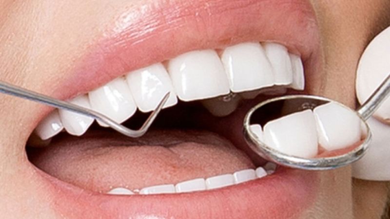 Bọc răng sứ Emax giá bao nhiêu? Cần lưu ý gì trước khi bọc Bọc răng sứ Emax giá bao nhiêu? Mức giá bọc răng sứ Emax dao động khá lớn