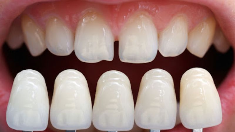 Bọc răng sứ Lava có tốt không? Lưu ý trước khi thực hiện Bọc răng sứ Lava được bác sĩ đánh giá cao về chất lượng