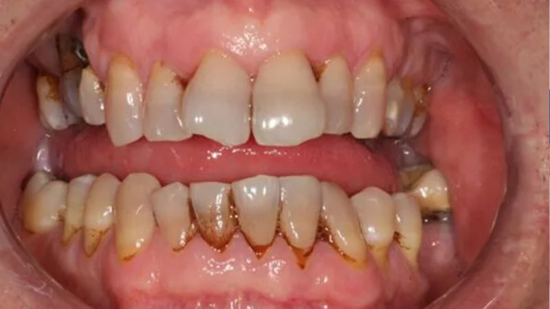 Bọc răng sứ titan có bị đen không? Lời khuyên từ bác sĩ Bọc răng sứ titan có bị đen không? Người bọc răng sứ titan sau nhiều năm rất dễ bị đen viền nướu