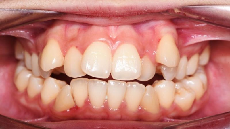 Bọc răng sứ titan có tốt không? Lưu ý trước khi thực hiện Với trường hợp răng bị lệch lạc quá nhiều, bọc răng sứ titan không thích hợp