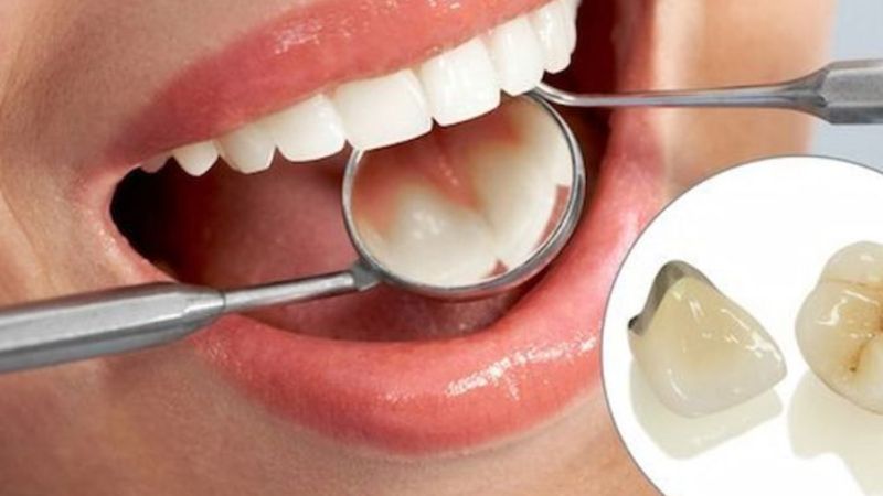 Bọc răng sứ titan được bao lâu? Các yếu tố quyết định Bọc răng sứ titan được bao lâu? Tuổi thọ của răng sứ titan có thể đạt đến 15 năm nếu được bảo vệ và chăm sóc tốt