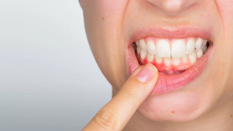 Mách bạn cách chữa đau nướu răng hiệu quả và ngừa tái phát Tùy nguyên nhân bác sĩ sẽ chỉ định làm sạch túi nha, điều trị tủy, nhổ răng,...