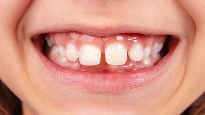 Dán sứ veneer không mài răng bền không? Lưu ý khi thực hiện Người có răng thưa không phù hợp để thực hiện dán sứ veneer không mài răng