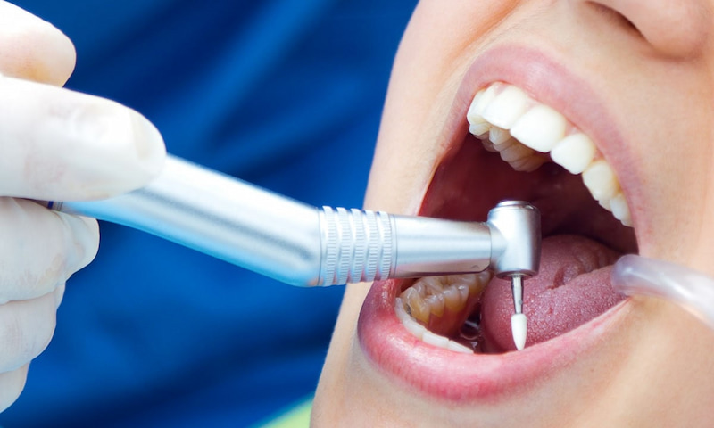 Đau dây thần kinh răng là gì? Dấu hiệu và cách xử lý an toàn Trám răng phù hợp với các ca đau chưa ảnh hưởng đến tủy