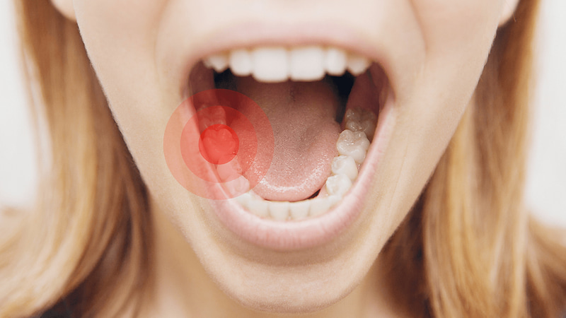Đau tủy răng là gì? Dấu hiệu nhận biết và cách điều trị Vi khuẩn đã xâm nhập sâu vào buồng tủy răng và gây đau viêm nặng