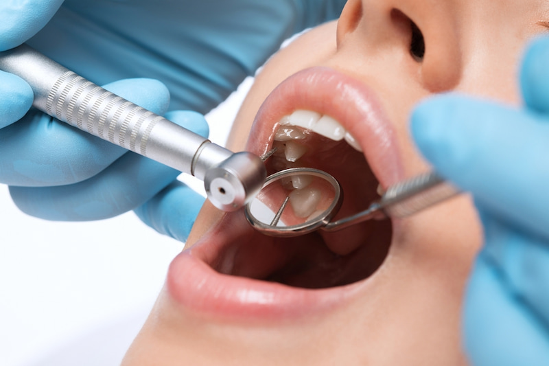 Đau tủy răng là gì? Dấu hiệu nhận biết và cách điều trị Bác sĩ sẽ mở buồng tủy và loại bỏ phần tủy bị nhiễm trùng