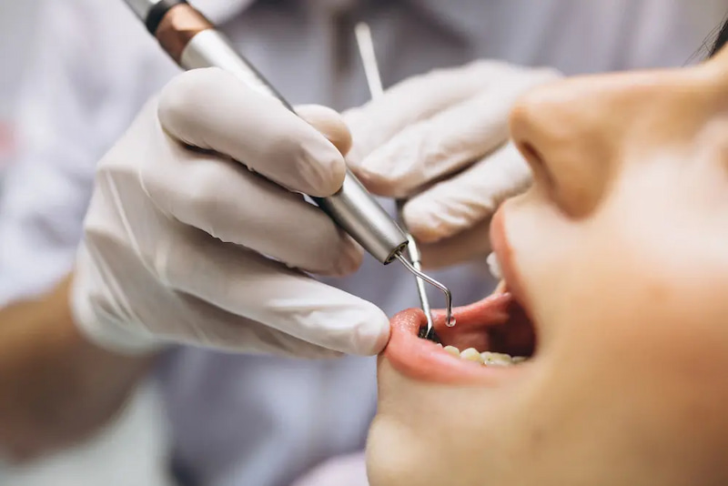 Lấy tủy răng có đau không và những điều cần biết trước Chưa lấy tủy răng triệt để khiến cơn đau nhức xuất hiện trở lại