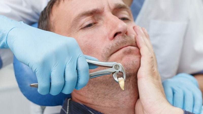 Nhổ răng số 3 hàm dưới nguy hiểm không? Khi nào bắt buộc nhổ? Sau khi nhổ răng số 3 nên trồng lại càng sớm càng tốt