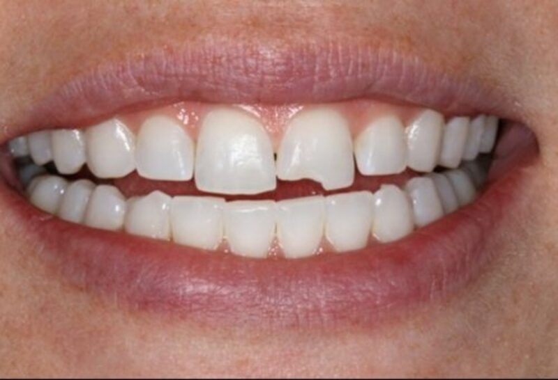 Răng bị bể lớn có bọc sứ được không? Giải pháp bảo tồn răng thật Răng bị bể lớn vẫn có thể bọc sứ nếu còn hiệu ứng vòng đai